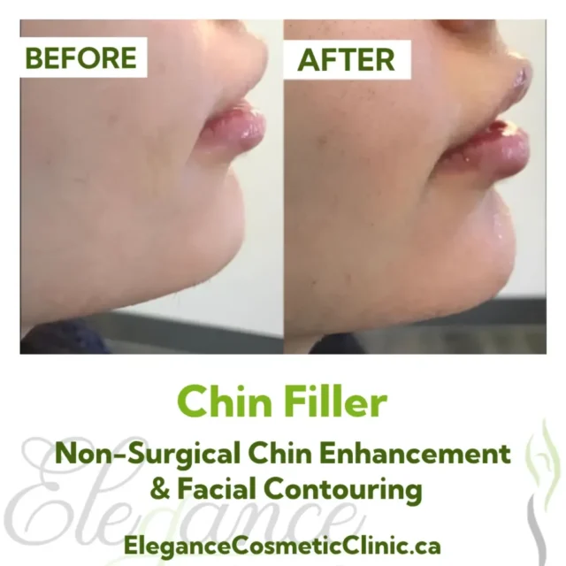 Before and After Chin Filler for Non-Surgical Chin Enhancement and Facial Contouring at Elegance Cosmetic Clinic