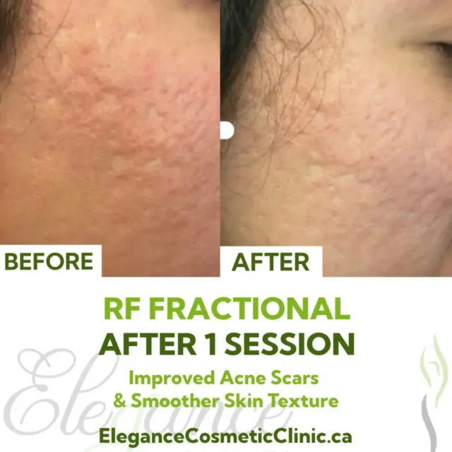 Before and After RF Fractional Treatment for Acne Scars and Skin Texture Improvement After 1 Session at Elegance Cosmetic Clinic