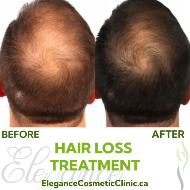 Before and after images showing hair restoration results for a man with thinning hair at the front of the scalp
