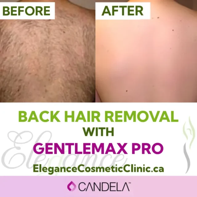 Before and After Back Hair Removal with GentleMax Pro Laser at Elegance Cosmetic Clinic