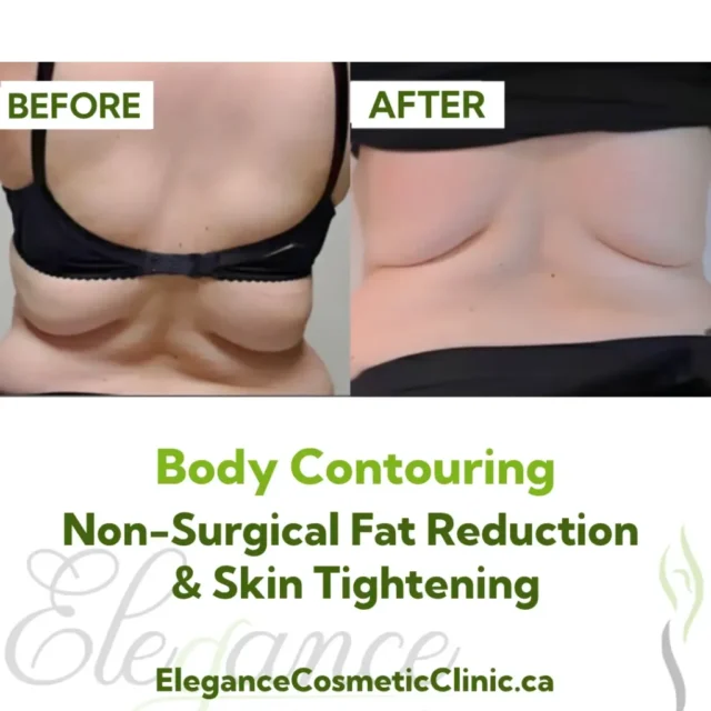 Before and After Body Contouring for Non-Surgical Fat Reduction and Skin Tightening at Elegance Cosmetic Clinic
