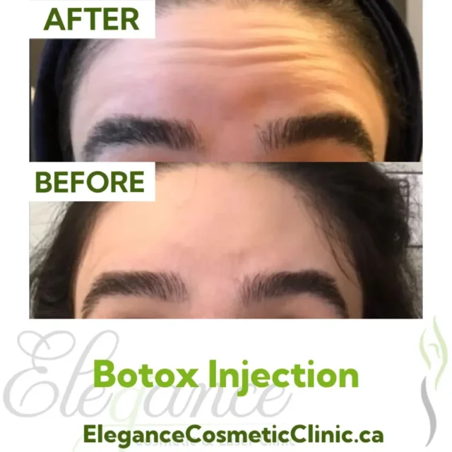 Before and After Botox Injection for Forehead Wrinkle Reduction at Elegance Cosmetic Clinic