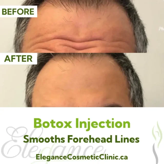 Before and After Botox Injection for Forehead Wrinkle Smoothing at Elegance Cosmetic Clinic