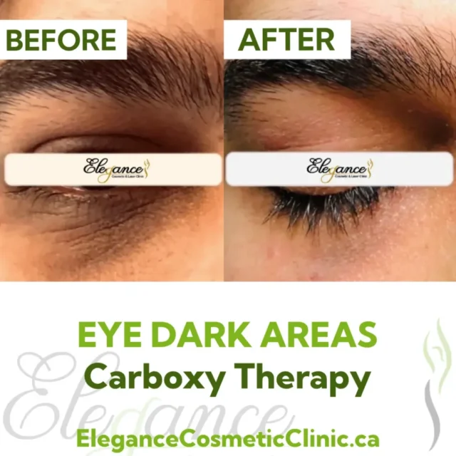Before and After Carboxy Therapy showing reduced dark circles and improved skin brightness under the eyes at Elegance Cosmetic Clinic