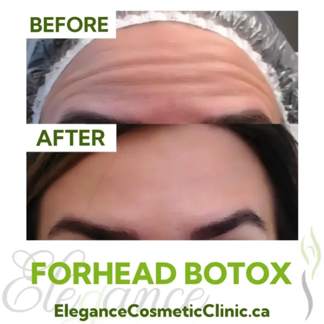 Before and After Forehead Botox Injection showing wrinkle reduction and smoother forehead at Elegance Cosmetic Clinic
