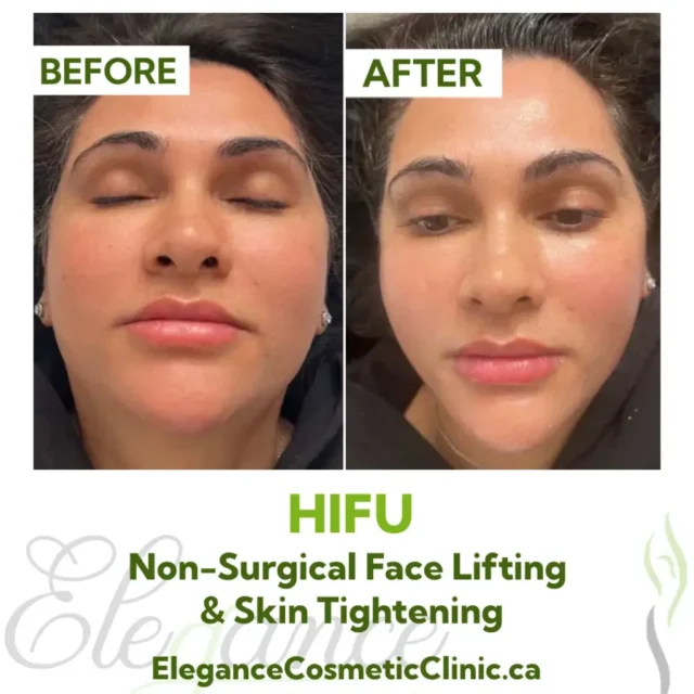 Before and After HIFU Face Lifting and Non-Surgical Skin Tightening Treatment at Elegance Cosmetic Clinic