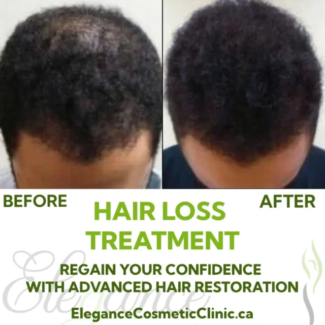 Before and after results of hair restoration treatment on the back of a man's head showing improved hair density