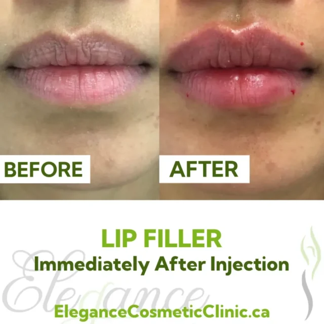 Before and After Lip Filler Injection showing immediate volume enhancement and fuller lips at Elegance Cosmetic Clinic