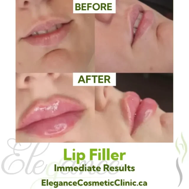 Before and After Lip Filler showing Immediate Volume Enhancement from Multiple Angles at Elegance Cosmetic Clinic
