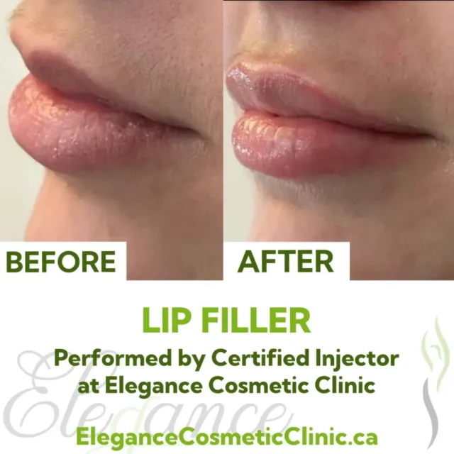 Before and After Lip Filler Injection for Lip Enhancement performed by Certified Injector at Elegance Cosmetic Clinic