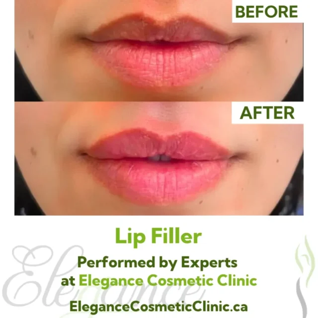 Before and After Lip Filler for Natural Lip Volume Enhancement at Elegance Cosmetic Clinic