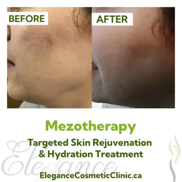 Before and After Mesotherapy Skin Rejuvenation and Hydration Treatment at Elegance Cosmetic Clinic