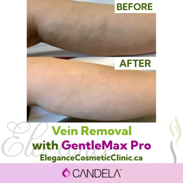 Before and After Vein Removal with GentleMax Pro Laser Treatment at Elegance Cosmetic Clinic