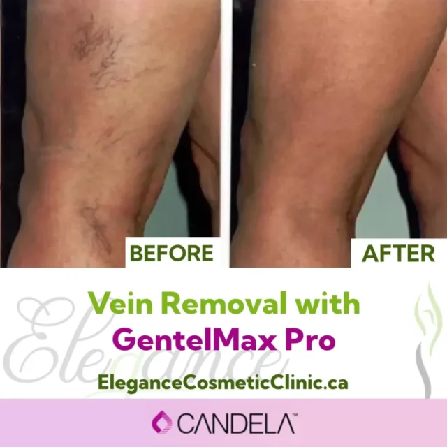 Before and After Vein Removal on Legs with GentleMax Pro Laser Treatment at Elegance Cosmetic Clinic