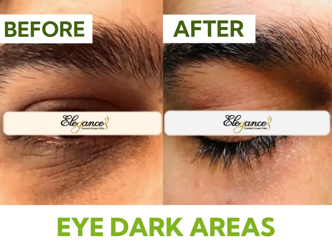Side-by-side comparison of dark under-eye circles before and after carboxytherapy treatment.