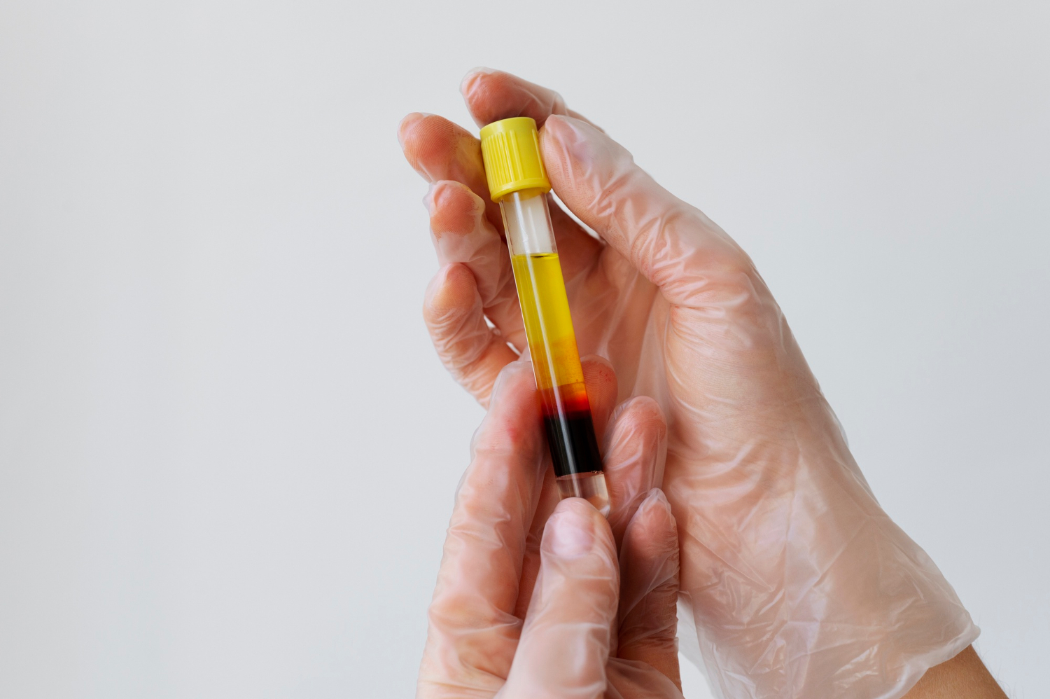 PRF Serum Separated After Centrifugation Gloved hands holding a centrifuged blood tube with golden PRF layer above red blood cells.