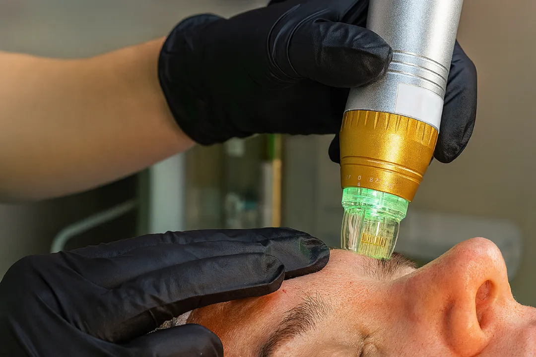 Gloved clinician holding a gold-and-silver radiofrequency microneedling handpiece with a glowing green tip against a patient’s forehead during an RF fractional skin-rejuvenation session.