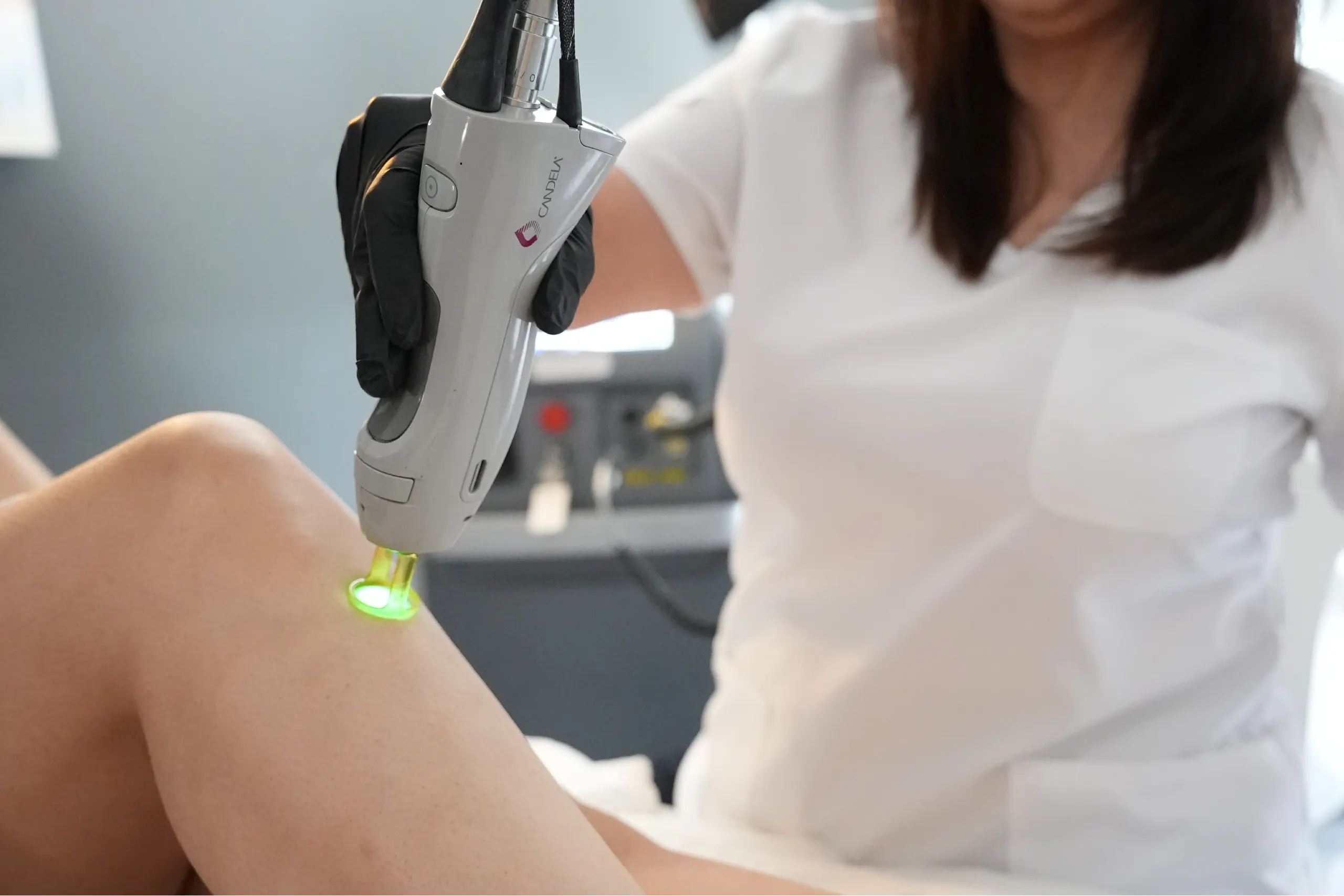 Laser hair removal treatment using Candela device on patient’s leg at Elegance Cosmetic & Laser Clinic