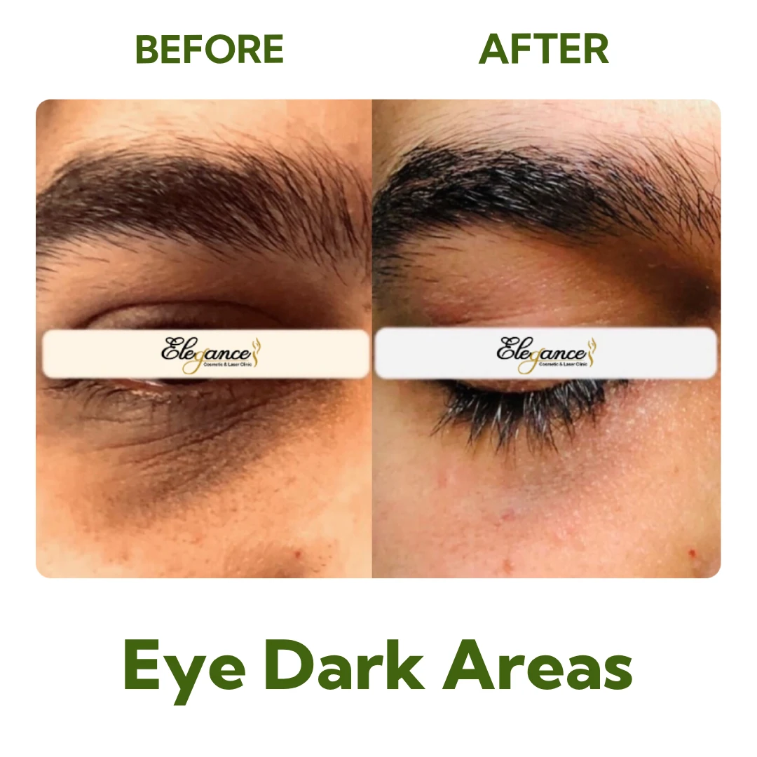 Before and After Carboxy Therapy showing reduced dark circles and improved skin brightness under the eyes at Elegance Cosmetic Clinic