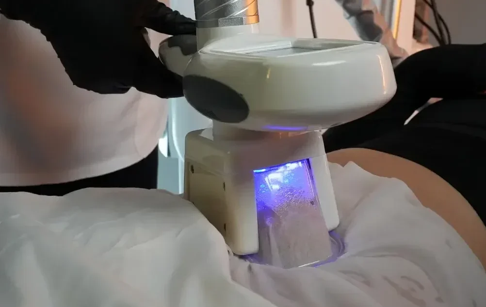 Close-up of cryolipolysis cooling applicator on a patient’s abdomen during a fat-freezing treatment, with blue light visible inside the device.