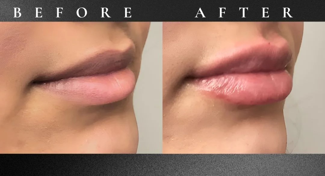 Skin Booster Hydration Treatment — Elegance Cosmetic & Laser Clinic Clinician preparing a syringe for skin booster treatment at Elegance Cosmetic & Laser Clinic