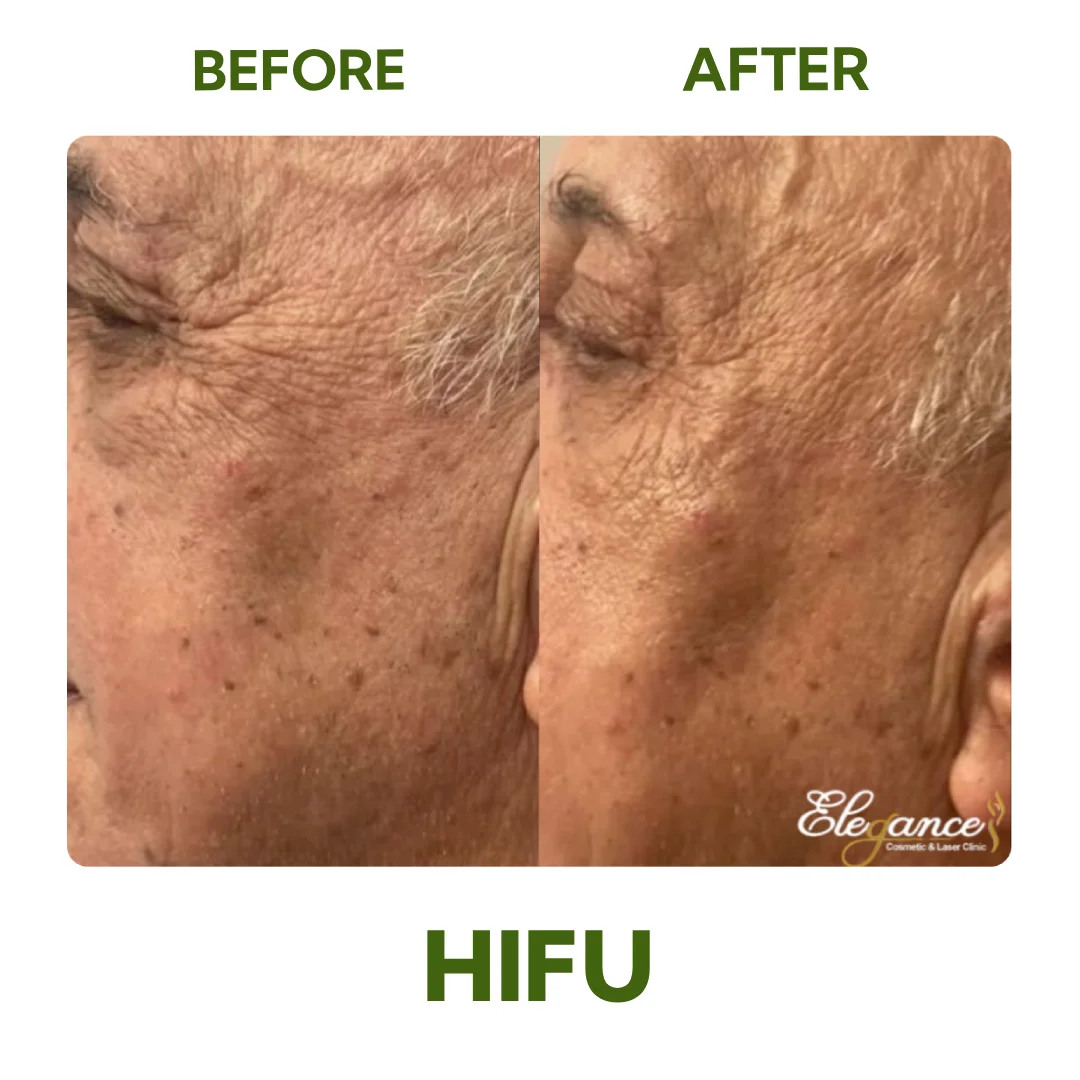Before and After HIFU Eye Area Skin Tightening and Wrinkle Reduction Treatment at Elegance Cosmetic Clinic
