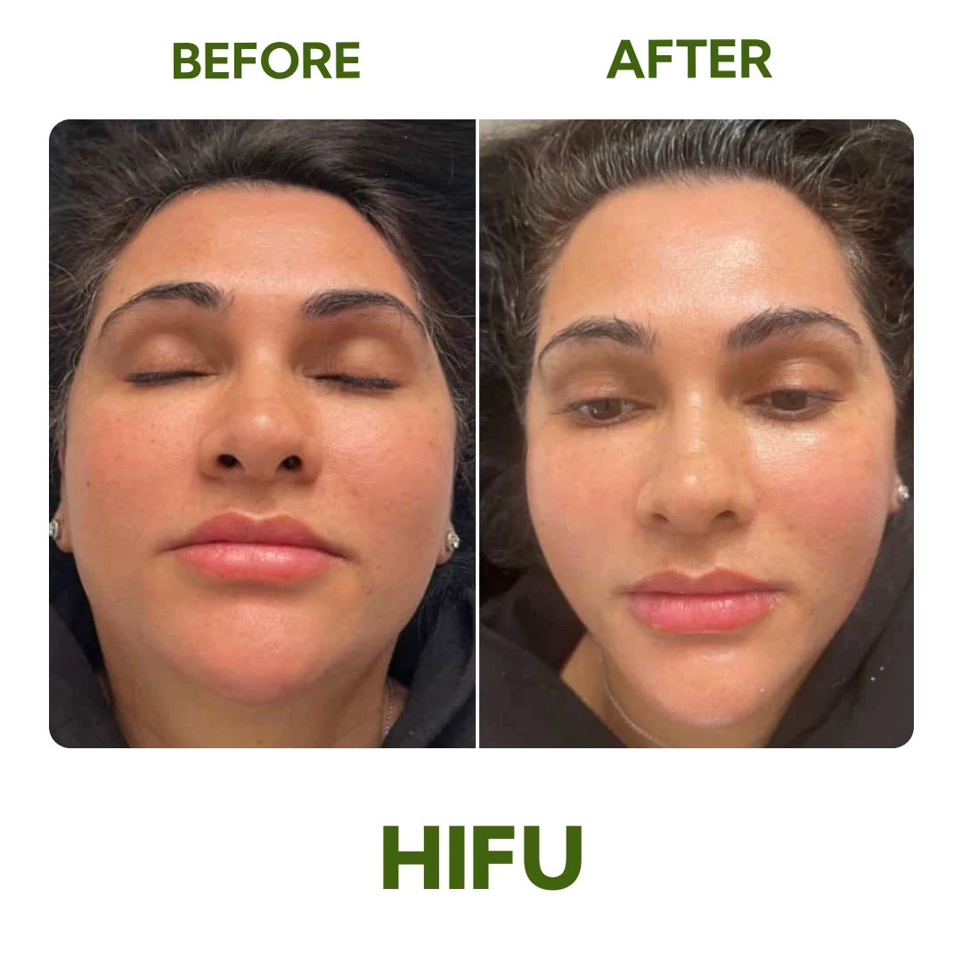 Before and After HIFU Face Lifting and Non-Surgical Skin Tightening Treatment at Elegance Cosmetic Clinic