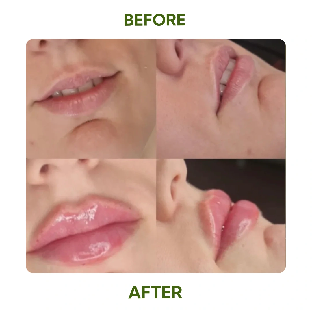 Before and After Lip Filler showing Immediate Volume Enhancement from Multiple Angles at Elegance Cosmetic Clinic