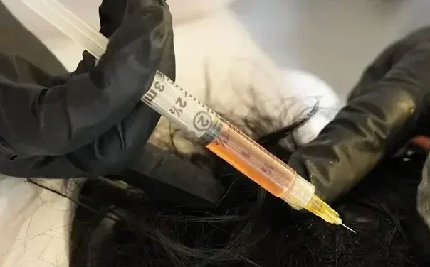 Clinician injecting platelet-rich plasma into a patient’s scalp for hair restoration