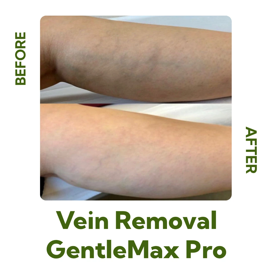 Before and After Vein Removal with GentleMax Pro Laser Treatment at Elegance Cosmetic Clinic
