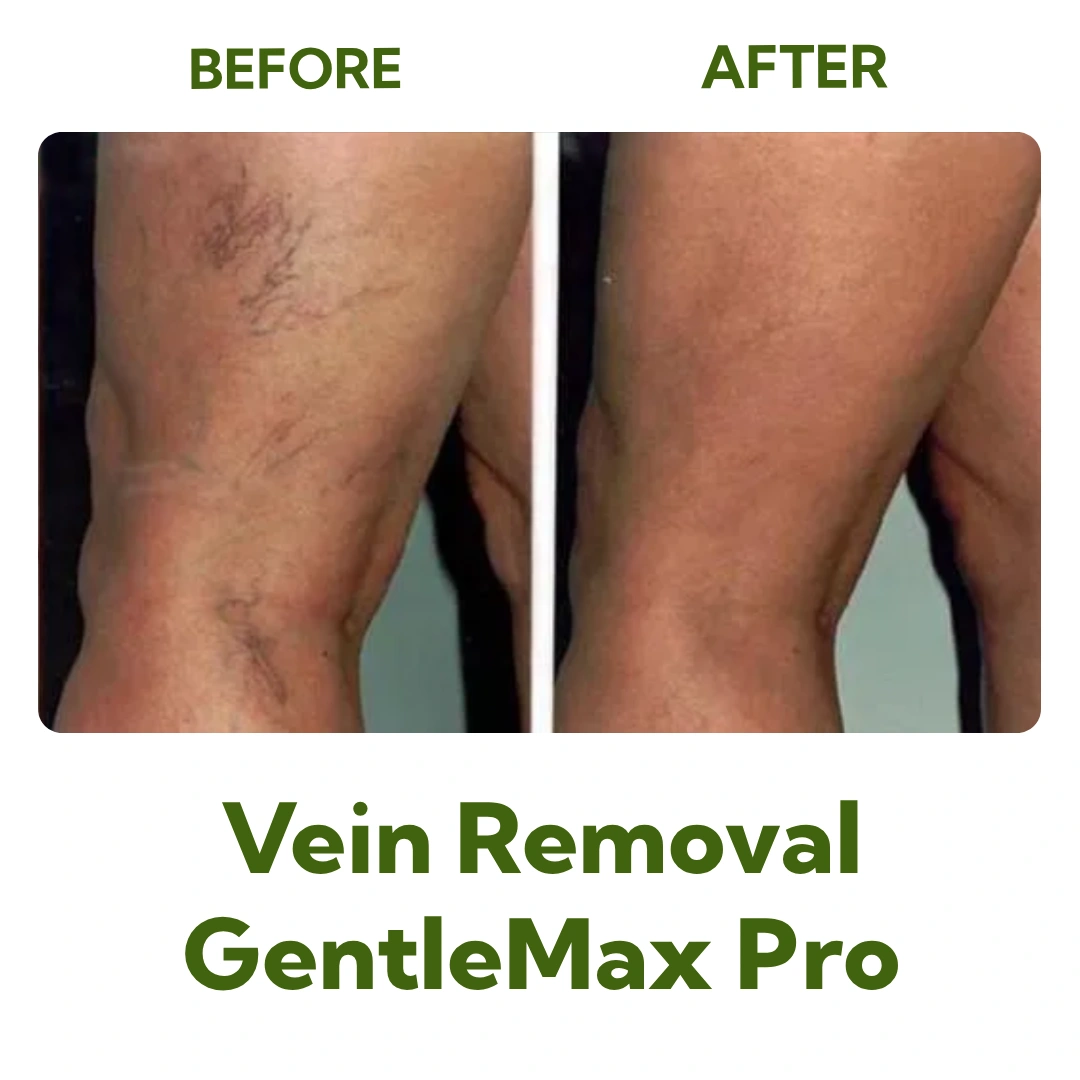 Before and After Vein Removal on Legs with GentleMax Pro Laser Treatment at Elegance Cosmetic Clinic