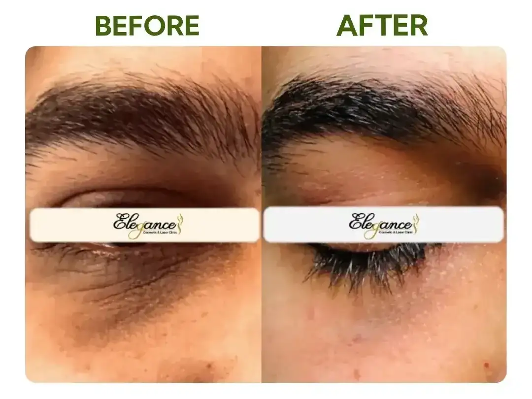 Tear Trough Filler Treatment — Elegance Cosmetic Clinic Patient receiving tear trough filler for under-eye hollowness